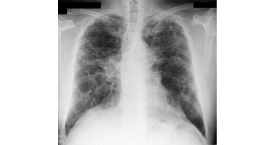 Program profilaktyki gruźlicy