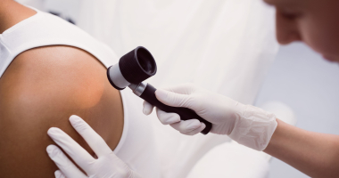 Sk&oacute;ra pod kontrolą. Poznaj ABCDE czerniaka 